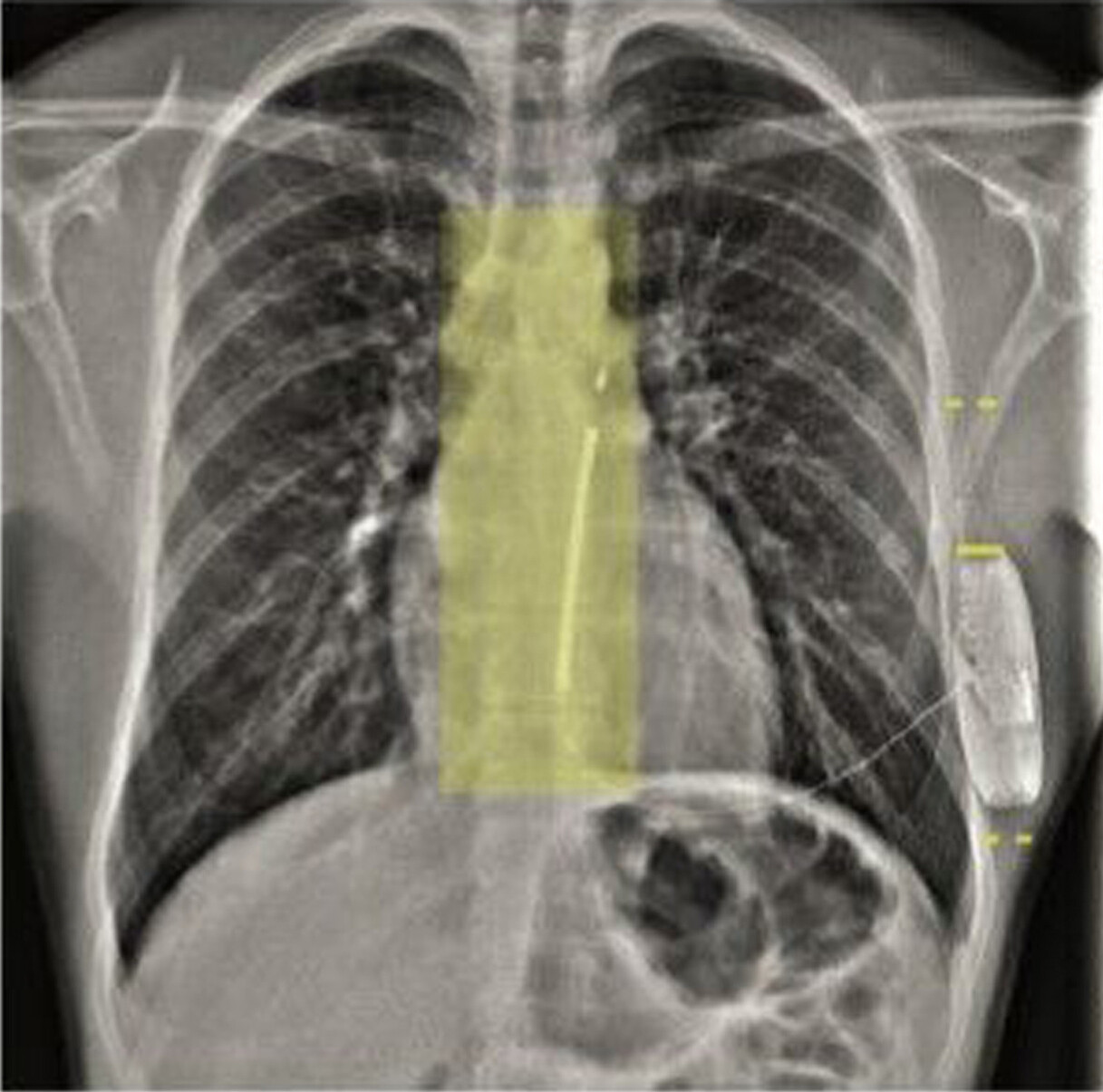 AP chest X-ray
