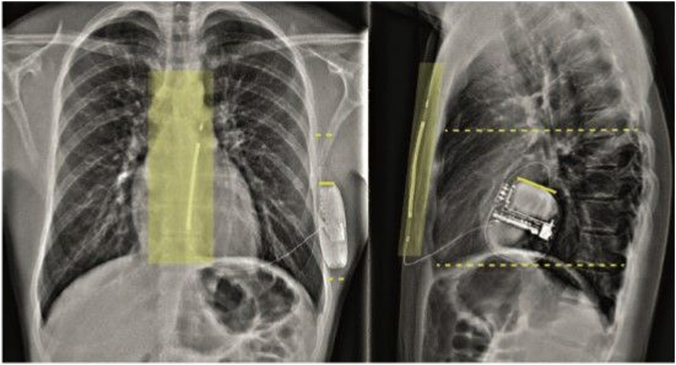 AP and Lateral chest X-ray