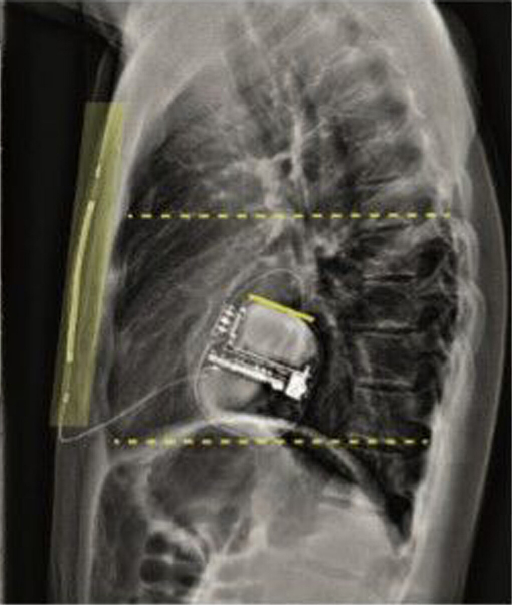 Lateral chest X-ray